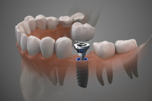 Things to Consider before Performing Dental Implants